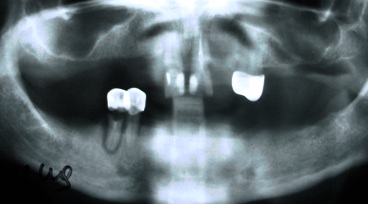 Пациент обратился в стоматологическую клинику Дентал Палас с жалобами на подвижность оставшихся зубов на нижней челюсти и неудовлетворительную фиксацию съёмного протеза.