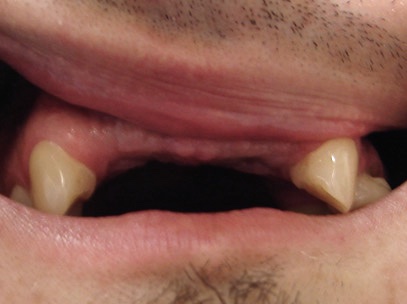 Пациент обратился с жалобами на дефект зубного ряда в переднем отделе верхней челюсти в области 12, 11, 21, и 22 зубов.