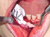 Для врачей стоматологов Схема пересадки костного блока с использованием нерезорбируемой мембраны Gore-Tex® размещена отдельным файлом.