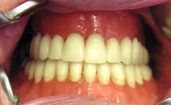 Примерка восковых моделей в полости рта.
