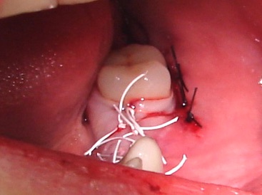 Следующим этапом лечения произведена установка имплантатов Astra-Tech в позиции клыка, первого премоляра, первого и второго моляра нижней челюсти справа.