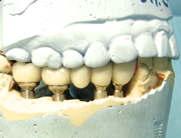 Используя дентальный компьютерный томограф получено изображение результата костной пластики. Определено плотное прилегание пересаженного участка костной ткани после чего удалена нерезорбируемая мембрана. Рана ушита нитью ПГА.