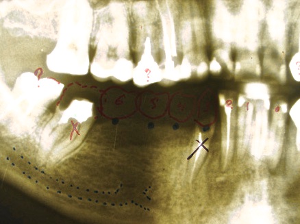 На ортопантомографии подтвержден достаточный запас костной ткани по высоте. 43 зуб удален ввиду обострения хронического периодонтита. 47 зуб удален по причине нецелесообразности лечения и восстановления.