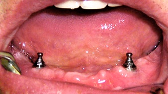 Вид слизистой оболочки альвеолярной части нижней челюсти с установленными абатментами (Сферические головки - имплантаты Конмет).