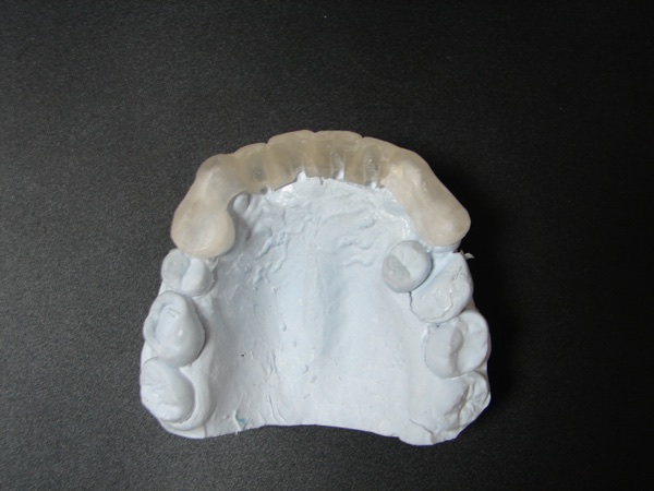 В зуботехнической лаборатории изготовлен пластмассовый проводник для правильного позиционирования имплантатов.