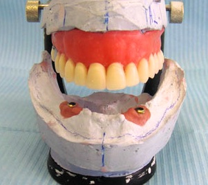 Вид модели с аналогами имплантатов и десневой маской