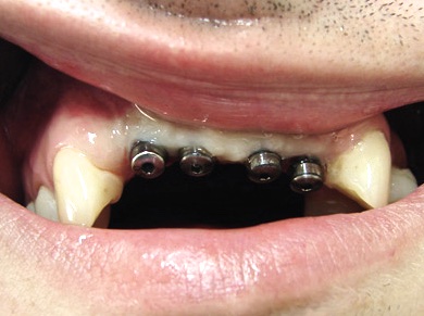 Вид зубного ряда и десны перед вторым этапом имплантации  