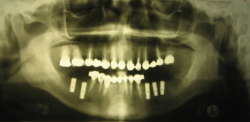 В область отсутствующих зубов установлены 3 и 2 двухэтапных имплантата Astra Tech OsseoSpeed диаметром 4.0 мм