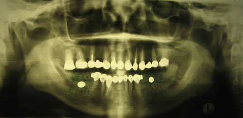 Пациент обратился с жалобами на отсутствие 36, 35, 34 и 45, 46 зубов и желанием протезирования несъемными зубными протезами.
