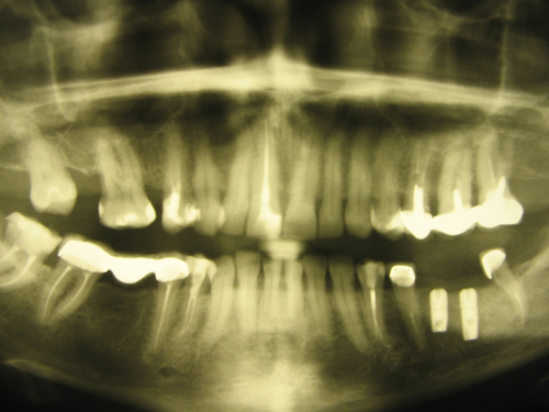 В соответствии с планом протезирования были установлены два имплантата Astra Tech в обл дефекта зубного ряда диаметром 4,0 мм. Контрольная рентгенограмма с установленными имплантатами