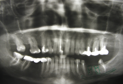 Пациент обратился в стоматологическую клинику МАПО с жалобами на отсутствие 36 и части 37 зуба (после гемисекции) и желанием иметь несъемный протез на имплантатах.