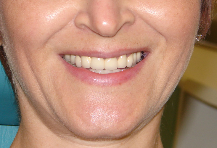 Фотография естественной улыбки с изготовленными протезами.  На верхней челюсти комбинация съемного (бюгельный) и несъемного протезов.  На нижней челюсти несъемный протез на имплантатах. 