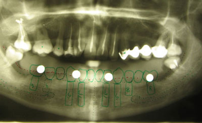 С использованием калибровочных шариков произведена рентгенография нижней челюсти, выбраны места установки имплантатов и их величина. В качестве операционного шаблона использовался временный съемный протез с подготовленными отверстиями 