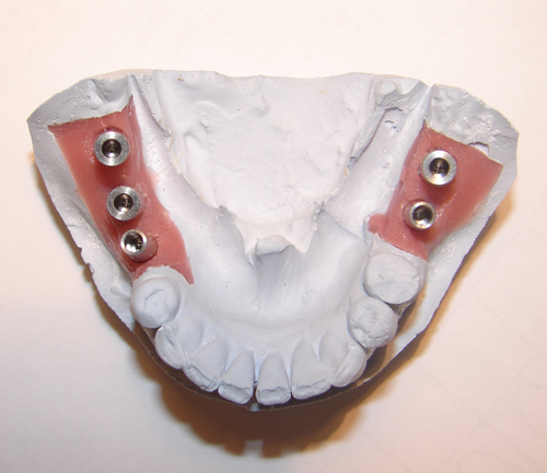 В установленные сроки начато протезирование на имплантатах верхней и нижней челюсти. Ортопедическая часть выполнена в зуботехнической лаборатории ООО СВК Ньюдент.