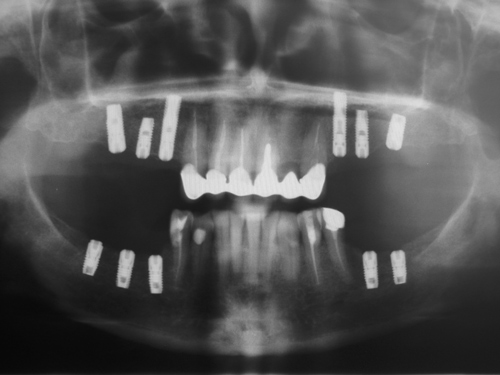 Через 3 недели после операции на верхней челюсти произведена установка имплантатов Astra Tech OsseoSpeed диаметром 4 мм в области отсутствующих 47, 46, 45, и 36, 37 зубов.