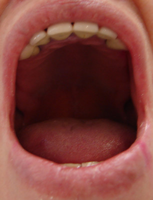 Пациент обратился с жалобами на отсутствие зубов (премоляры и моляры слева и справа на верхней и нижней челюсти) и желанием иметь несъемный протез на имплантатах.