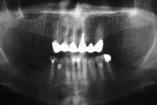 При рентгенологическом обследовании выявлен недостаточный запас костной ткани в области дна правой верхнечелюстной пазухи. Запланировано оперативное вмешательство по установке имплантатов с одновременным 