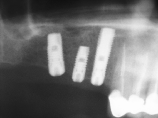 На ортопантомограмме в области проведенного поднятия дна верхнечелюстной пазухи прослеживается рентгенологическая структура костной ткани. 