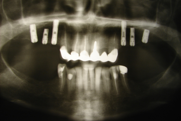 После проведенной операции выполнена контрольная ренгенография оперируемой области. Тень имплантата области отсутствующего 16-го зуба наслаивается на область пересаженной в пазуху костной крошки.