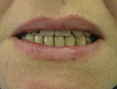 Пациент П 40 лет обратился в стоматологическую клинику в декабре 2005 года с жалобами на болевые ощущения в области опорных зубов нижней челюсти, обнажение корней зубов, подвижность ортопедической конструкции вместе с опорными зубами, запах изо-рта, воспаление десны и желанием провести рациональное протезирование. 