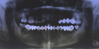 На ОПТГ определяется резорбция костной ткани вокруг опорных зубов, атрофия нижней челюсти по высоте. При планировании лечения и протезирования пациент выбирает несъемное протезирование с использованием двухэтапных имплантатов
