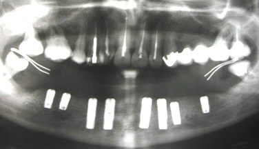 Установленные на нижней челюсти имплантаты. Шаронов И.В. - врач стоматолог-хирург, имплантолог.