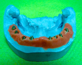 Вид модели с установленными 20-и градусными абатментами.  Шаронов И.В. - врач стоматолог-хирург, имплантолог.