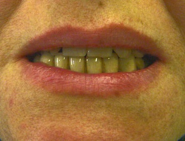 На нижней челюсти несъемный протез на имплантатах. Шаронов И.В. - врач стоматолог-хирург, имплантолог.