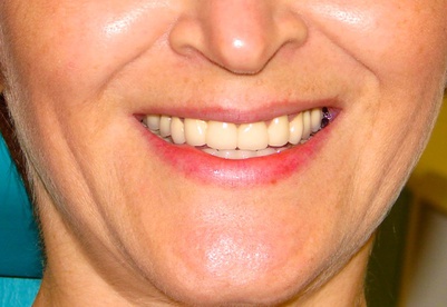Фотография естественной улыбки с изготовленными протезами. Шаронов И.В. - врач стоматолог-хирург, имплантолог.