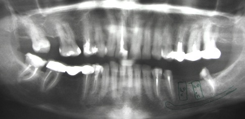Рентгенограмма исходной картины. Шаронов И.В. - врач стоматолог-хирург, имплантолог.