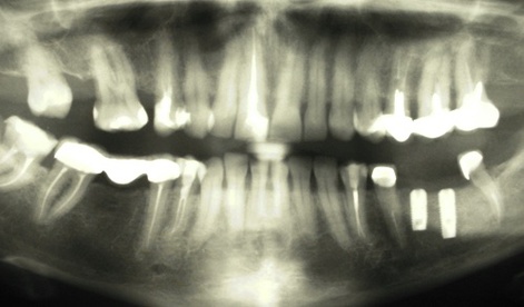Снимок после установки имплантатов. Шаронов И.В. - врач стоматолог-хирург, имплантолог.