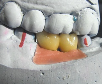 Готовый протез перед установкой на имплантаты. Шаронов И.В. - врач стоматолог-хирург, имплантолог.