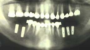 Рентгенограмма после установки имплантатов. Шаронов И.В. - врач стоматолог-хирург, имплантолог.