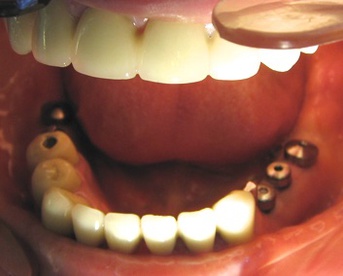 Вид с установленными формирователями десны. Шаронов И.В. - врач стоматолог-хирург, имплантолог.