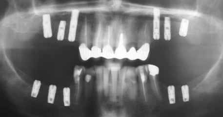Рентгенограмма после имплантации нижней челюсти