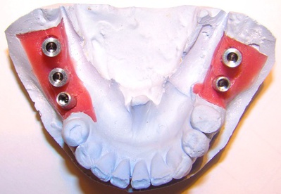 зуботехническая модель с моделированной десной 