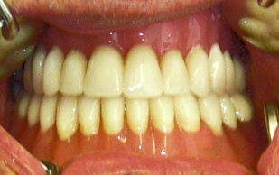Соотношение протезов в полости рта. Шаронов И.В. - врач стоматолог-хирург, имплантолог.