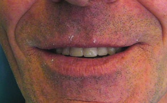 Вид при естественой улыбке. Нижний съемный протез фиксирован на двух имплантатах Конмет. Шаронов И.В. - врач стоматолог-хирург, имплантолог.