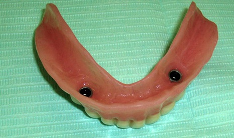 Вид базиса съемного протеза с установленными фиксирующими элементами. Шаронов И.В. - врач стоматолог-хирург, имплантолог.