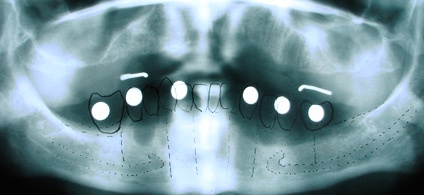 Снимок с рентгеноконтрастными метками. Шаронов И.В. - врач стоматолог-хирург, имплантолог.