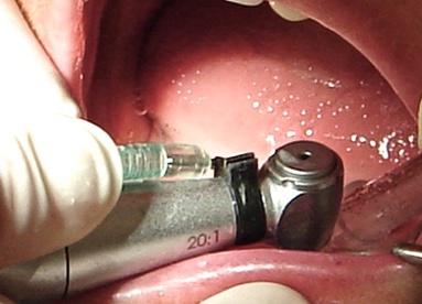 Сверление ложа для имплантата. Шаронов И.В. - врач стоматолог-хирург, имплантолог.