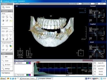 Трехмерное изображение компьютерной томографии. Шаронов И.В. - врач стоматолог-хирург, имплантолог.