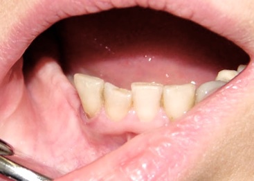 Картина в полости рта. Отсутствие зубов в боковом участке. 