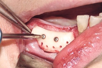 Фиксация костного блока винтами. Шаронов И.В. - врач стоматолог-хирург, имплантолог.
